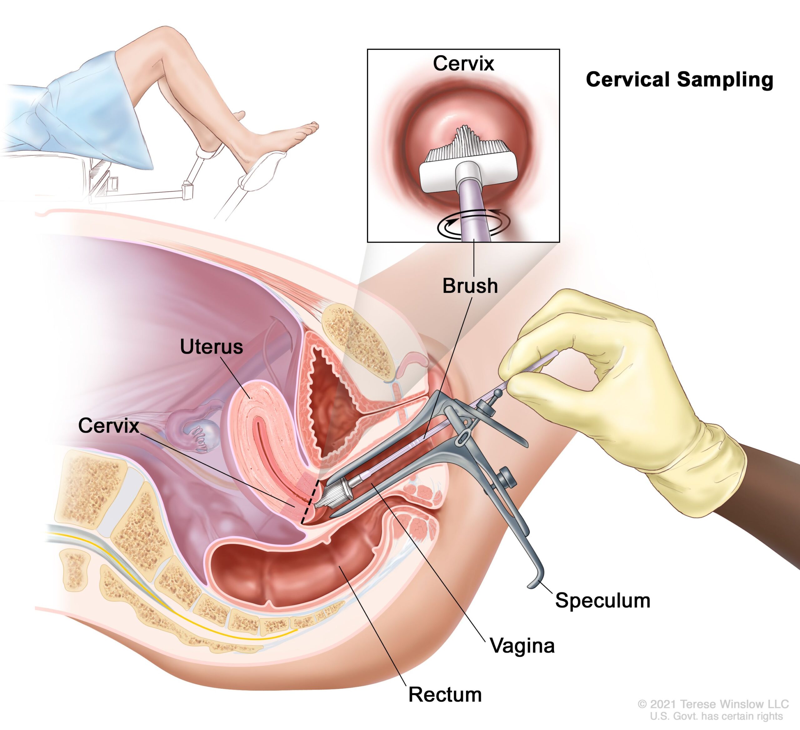 Cervical screening